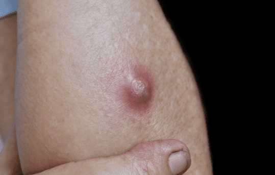 Leech Therapy Centre UK|Boils